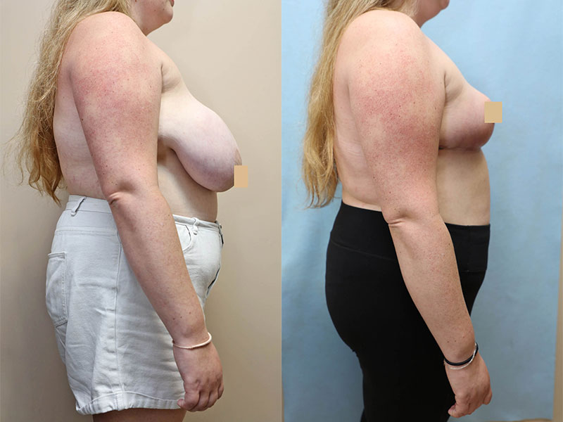 breast reduction before and after right