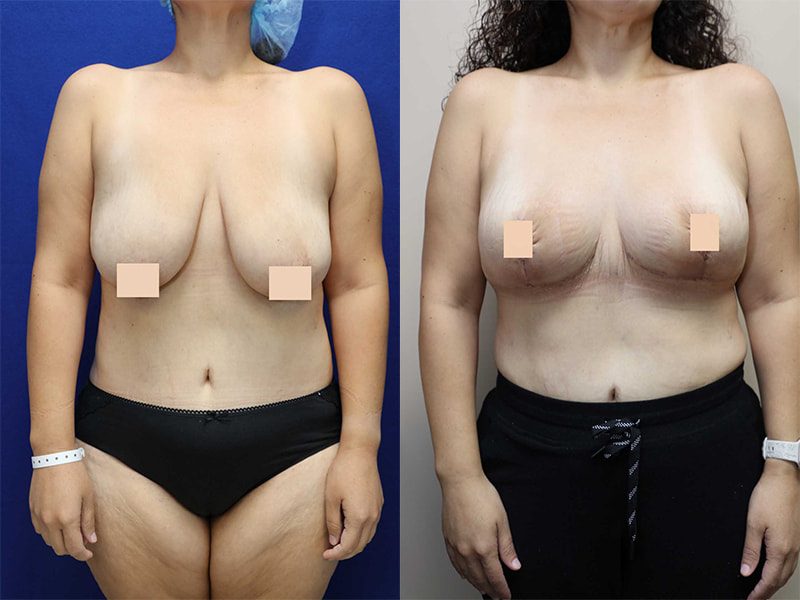 breast reduction before and after front