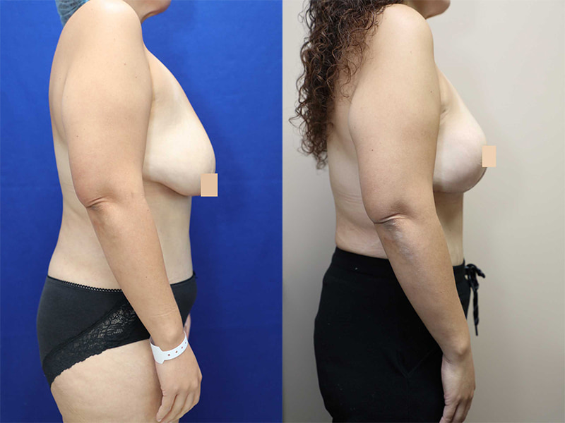 breast reduction before and after right