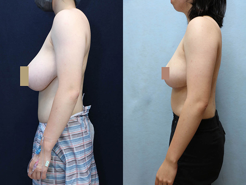 bilateral breast reduction before and after left