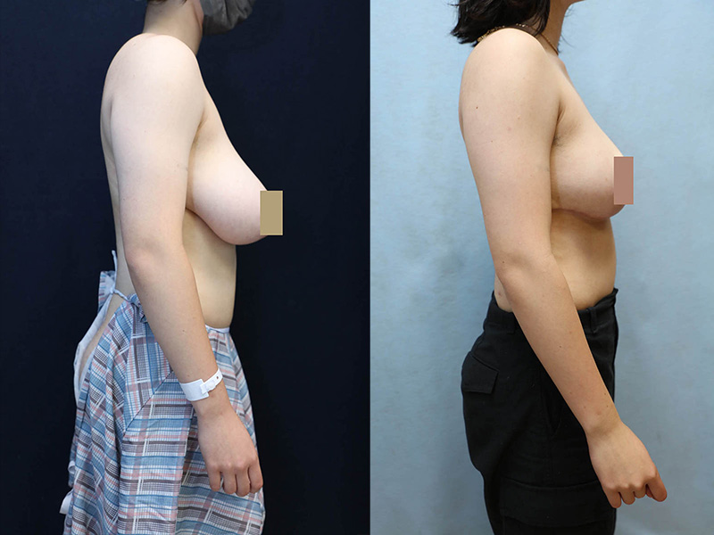 bilateral breast reduction before and after right