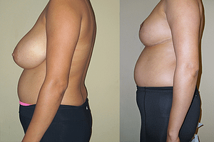Breast Reduction Before & After Photos