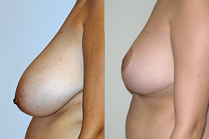 Breast Reduction Before & After Photos