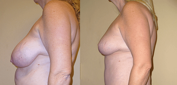Breast Reduction Before & After Photos