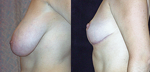 Breast Reduction Before & After Photos