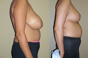 Breast Reduction Before & After Photos