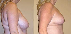Breast Reduction Before & After Photos