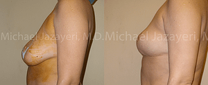 Breast Reduction Before & After Photos