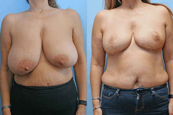 breast reduction before and after