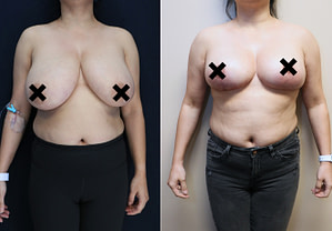 bilateral breast reduction before and after front