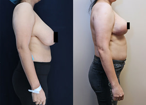 bilateral breast reduction before and after right