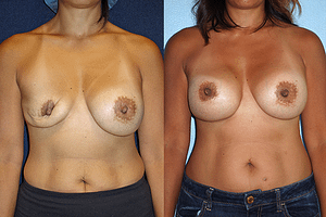 Breast Revision Before & After Photos