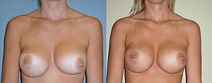 Breast Revision Before & After Photos