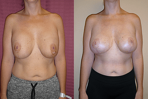 Breast Revision Before & After Photos Front