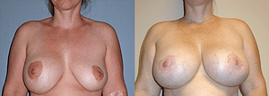 Breast Revision Before & After Photos Front