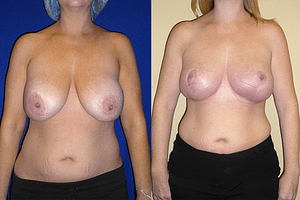 Breast Reduction Before & After Photos Front