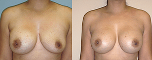 Breast Revision Before & After Photos