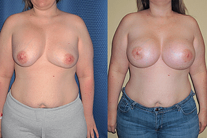 Breast Revision Before & After Photos