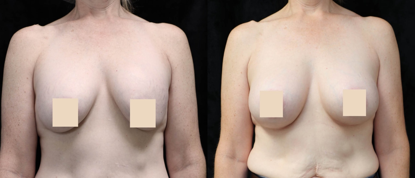Breast Revision Before & After Photos