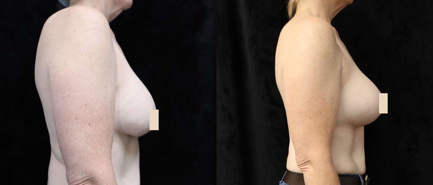 Breast Revision Before & After Photos