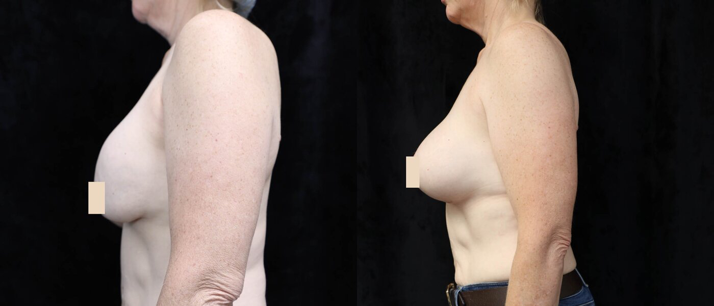 Breast Revision Before & After Photos