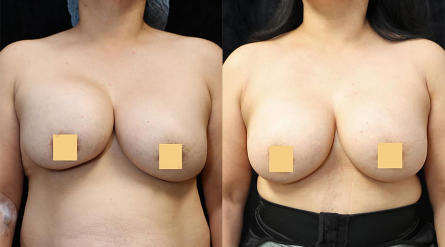 Breast Revision Before & After Photos