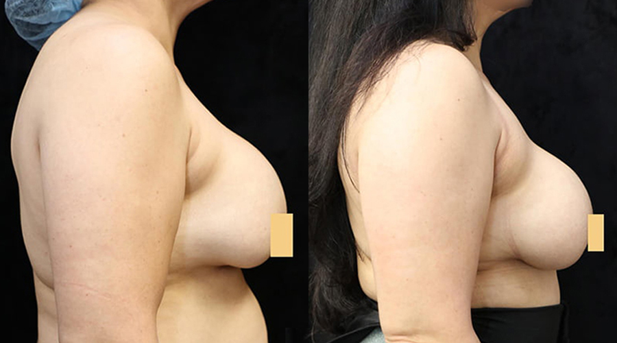 Breast Revision Before & After Photos