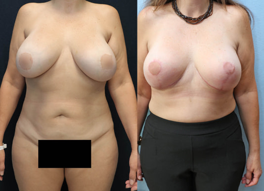 Breast Revision Before & After Photos