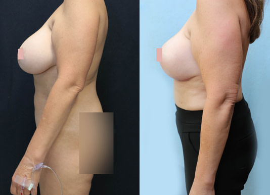 Breast Revision Before & After Photos