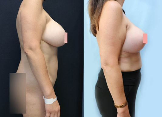 Breast Revision Before & After Photos