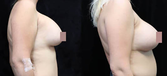 Breast Revision Before & After Photos