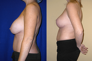 Breast Reduction Before & After Photos