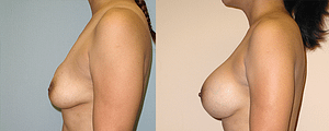 Breast Revision Before & After Photos Left