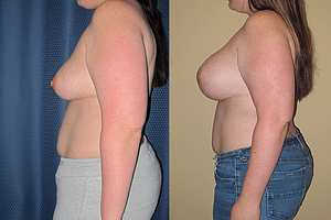 Breast Revision Before & After Photos