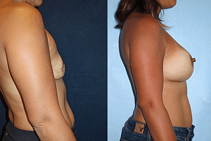 Breast Revision Before & After Photos Right