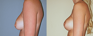 Breast Revision Before & After Photos Left