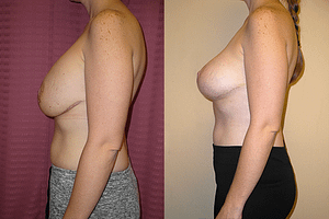 Breast Revision Before & After Photos Left