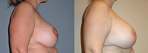 Breast Revision Before & After Photos Right