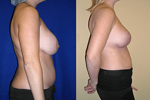 Breast Reduction Before & After Photos Right