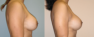 Breast Revision Before & After Photos