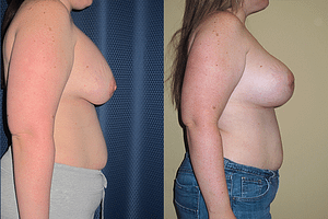Breast Revision Before & After Photos