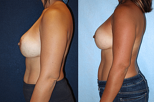 Breast Revision Before & After Photos