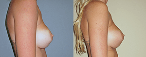 Breast Revision Before & After Photos Right
