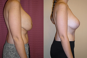 Breast Revision Before & After Photos Right