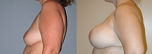 Breast Revision Before & After Photos Left