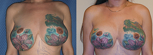 Breast Revision Before & After Photos Front