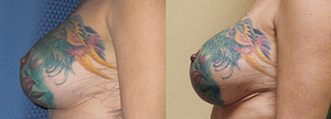 Breast Revision Before & After Photos Left