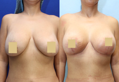 Breast Revision Before & After Photos