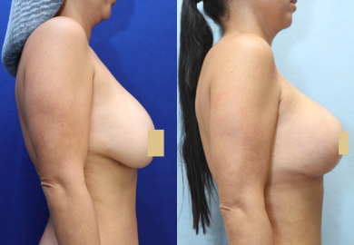 Breast Revision Before & After Photos