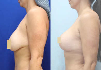 Breast Revision Before & After Photos